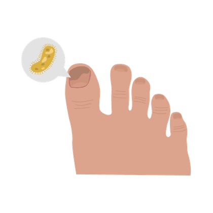 Nagelpilz (Onychomykose) und Fußpilz (Fußpilz)